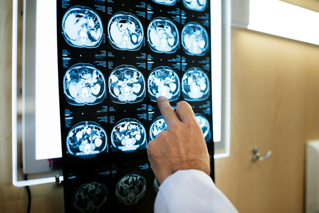 Doctor pointing at x-rays of a brain.